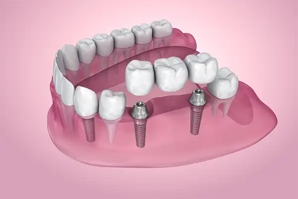 Rendering of a dental implant bridge being placed over a missing tooth gap with implant posts